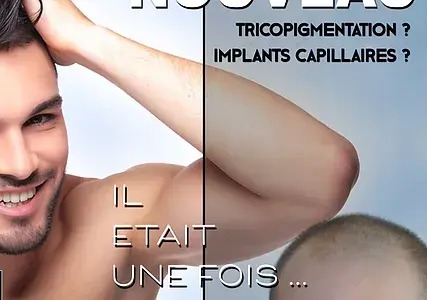 implants capillaires, tricopigmentation